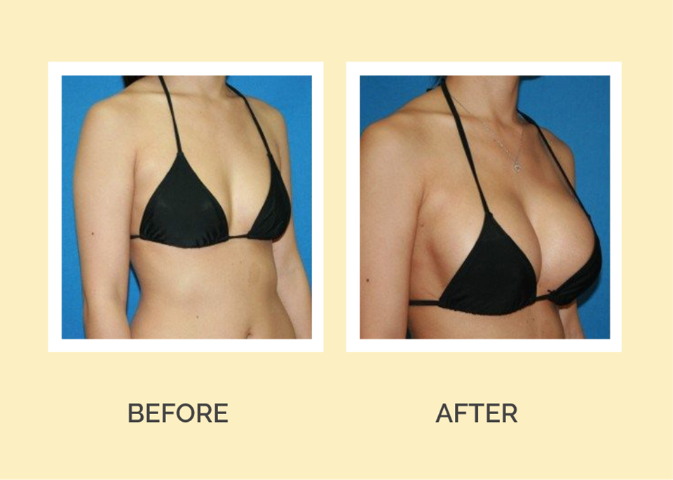 Breast Augmentation Surgery Dallas
