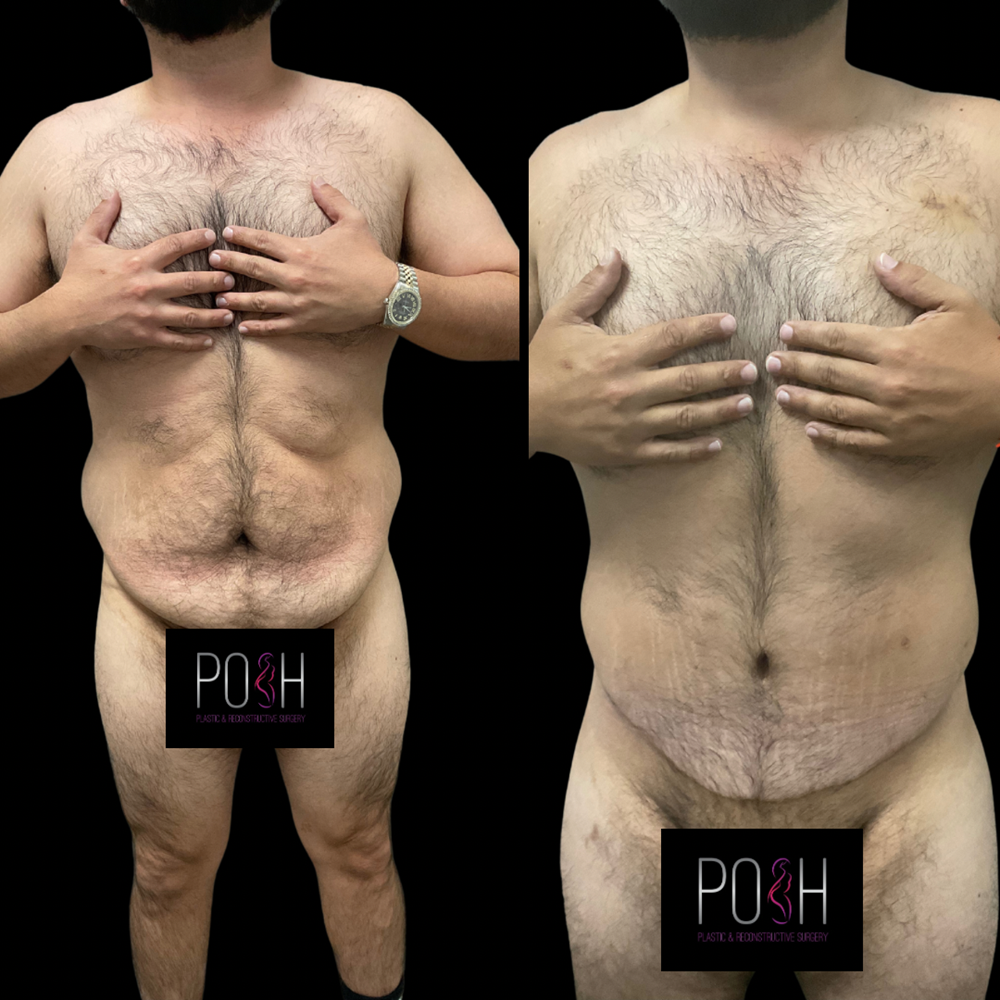 Daddy Makeover Surgery Dallas