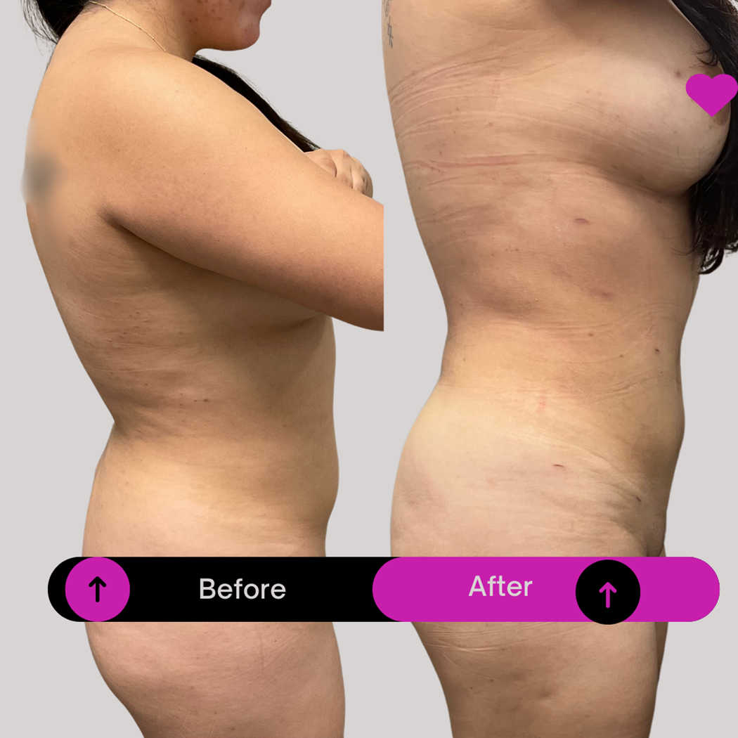 Lipo 360 Mansfield TX