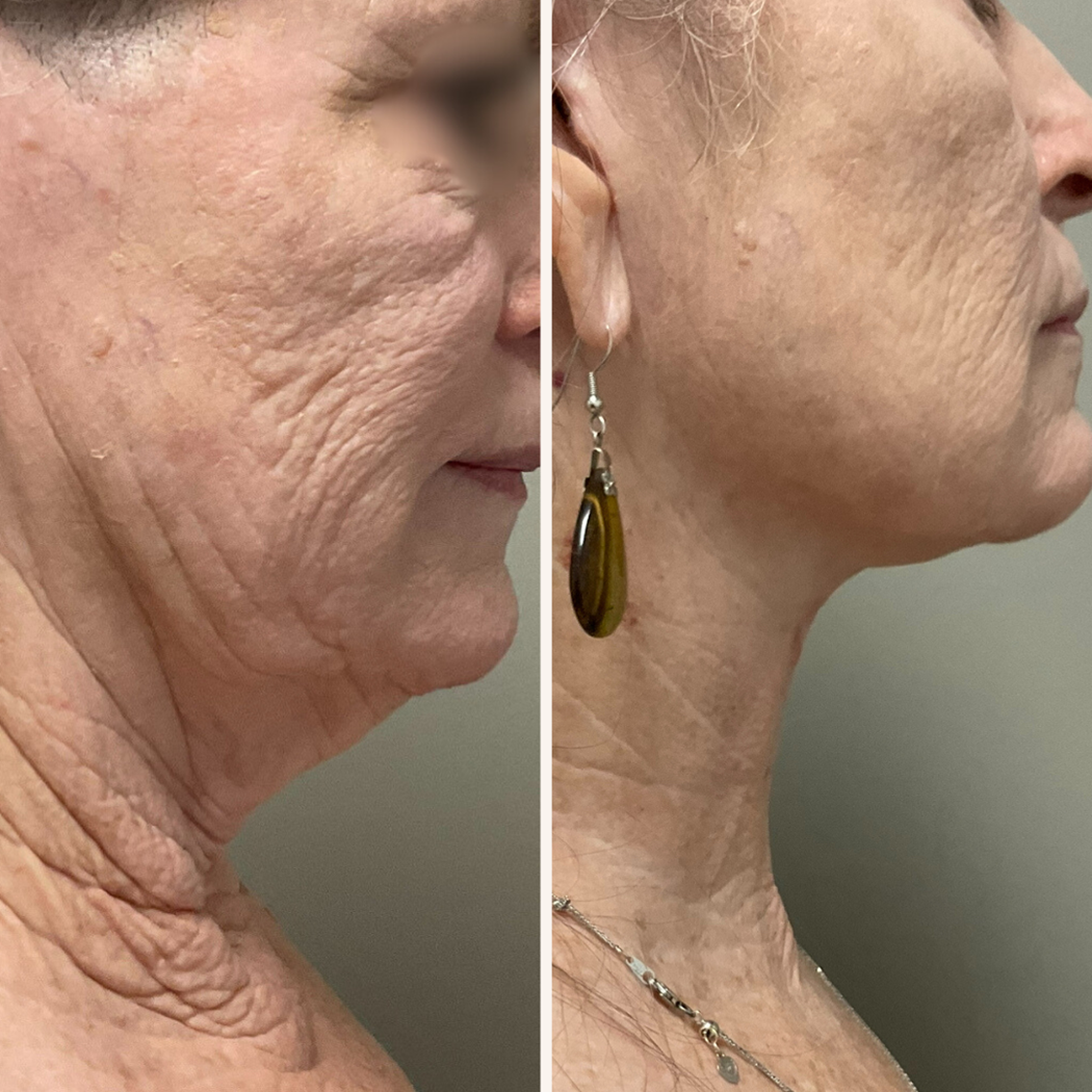 Neck Lift Kennedale TX