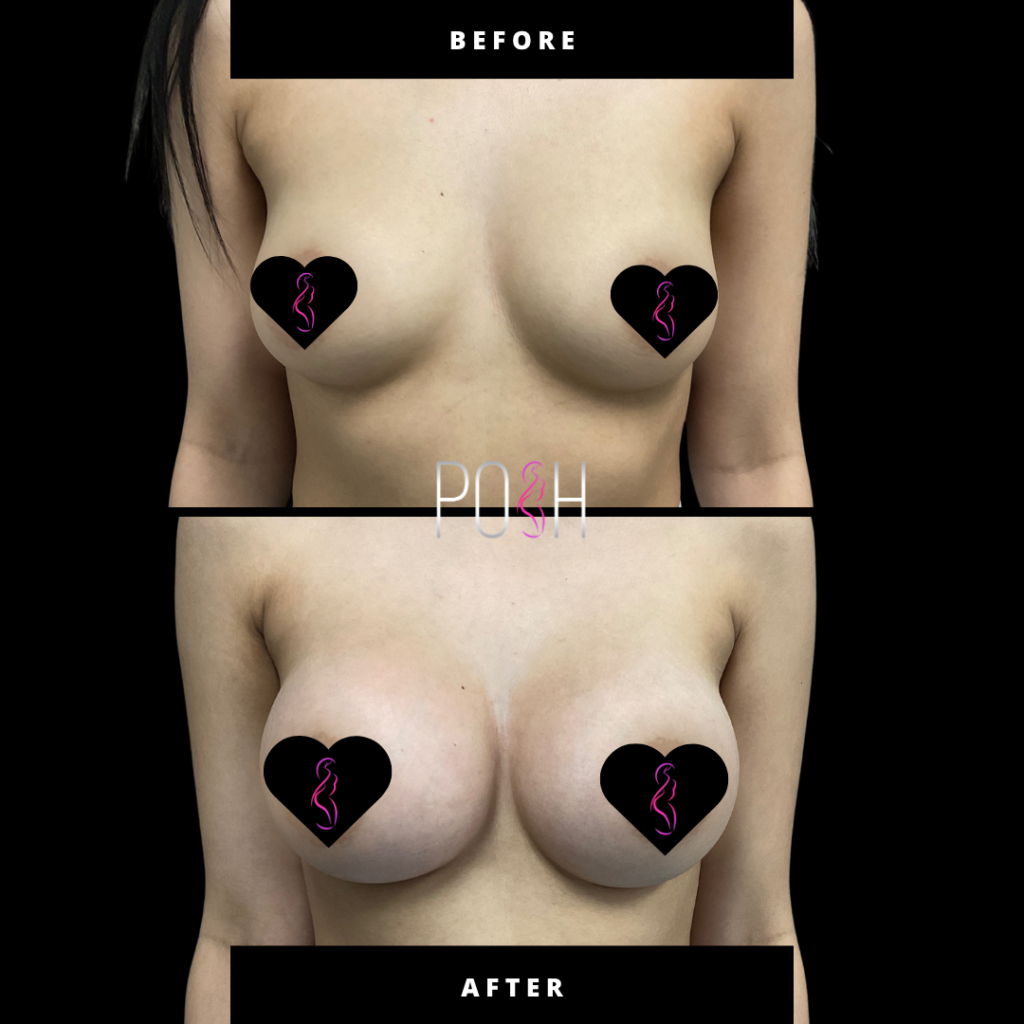 Breast augmentaion 1